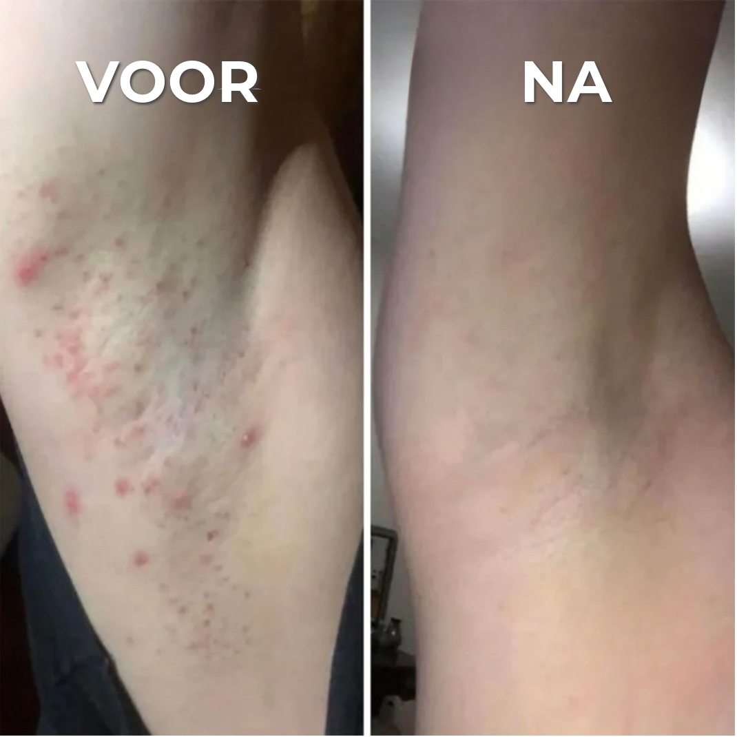 Professioneel Anti-Uitslag Scheerapparaat