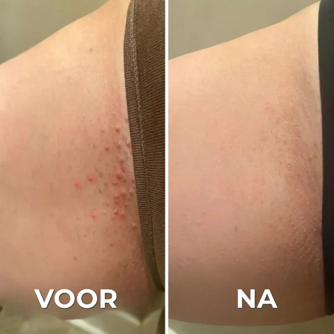 Professioneel Anti-Uitslag Scheerapparaat