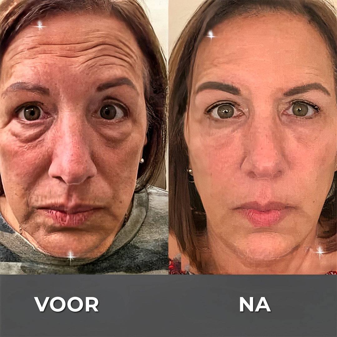 BOTOX™ Anti-Rimpelcrème