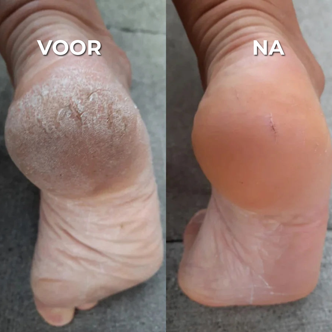 Novaloza™ | Professionele Eeltverwijderaar