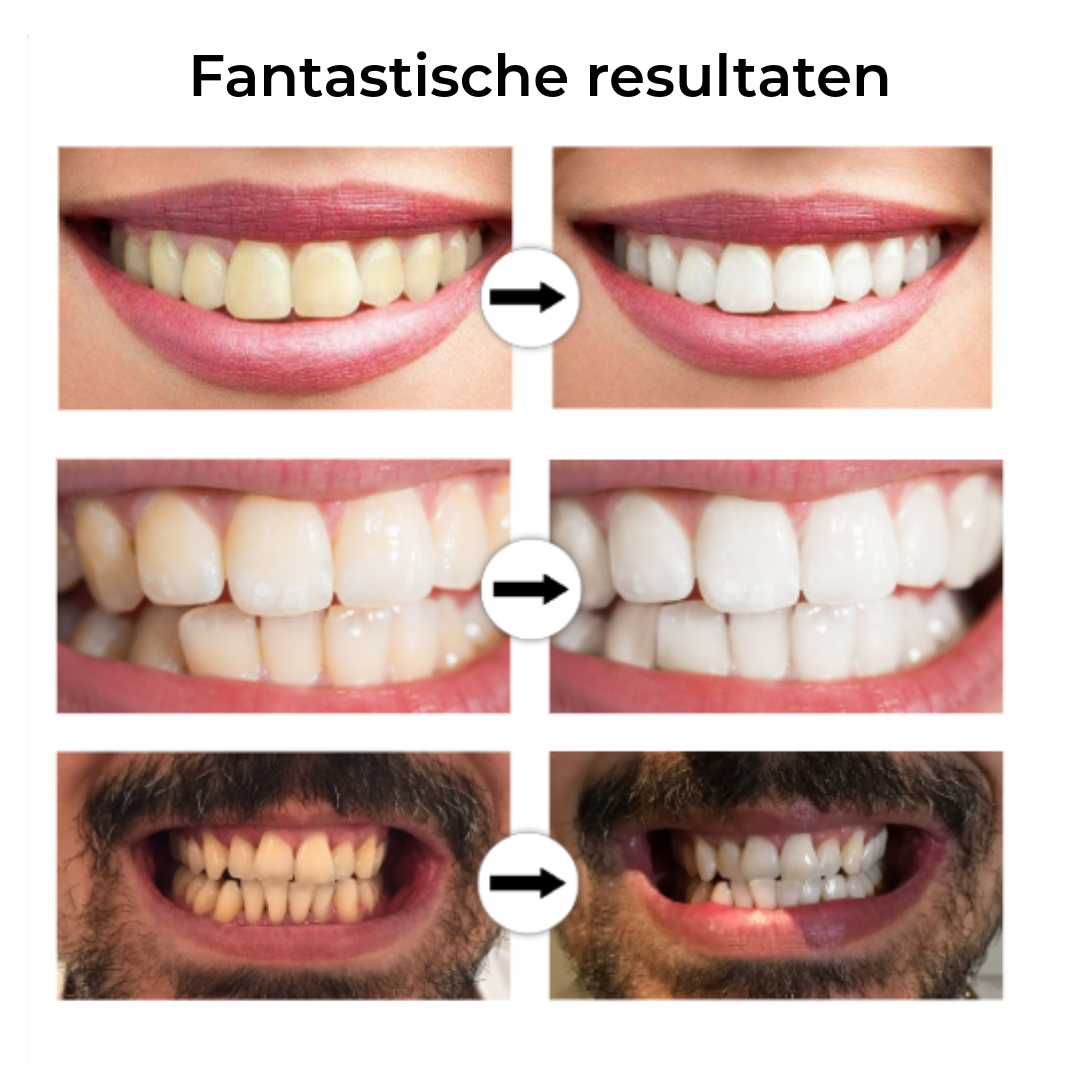 Professionele Tandenbleekstick