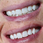 Professionele Tandenbleekstick
