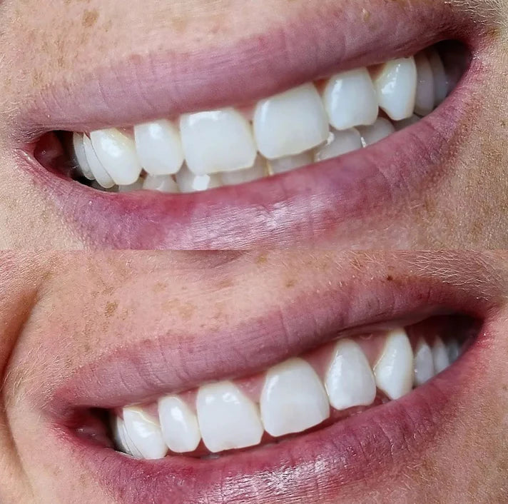 Professionele Tandenbleekstick
