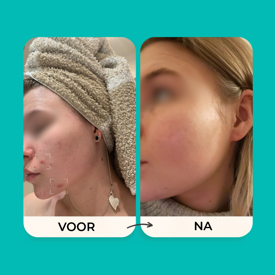 BHA Anti-Acne Masker